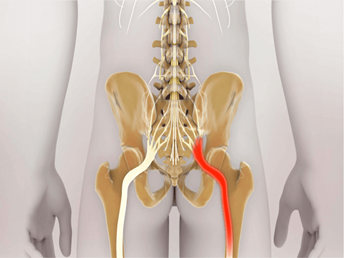 Sciatica​ Treatment