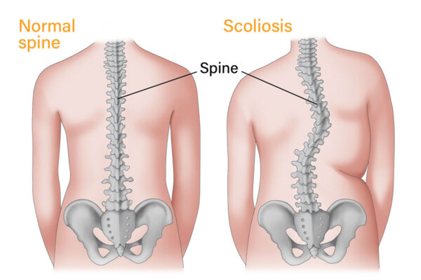 Scoliosis
