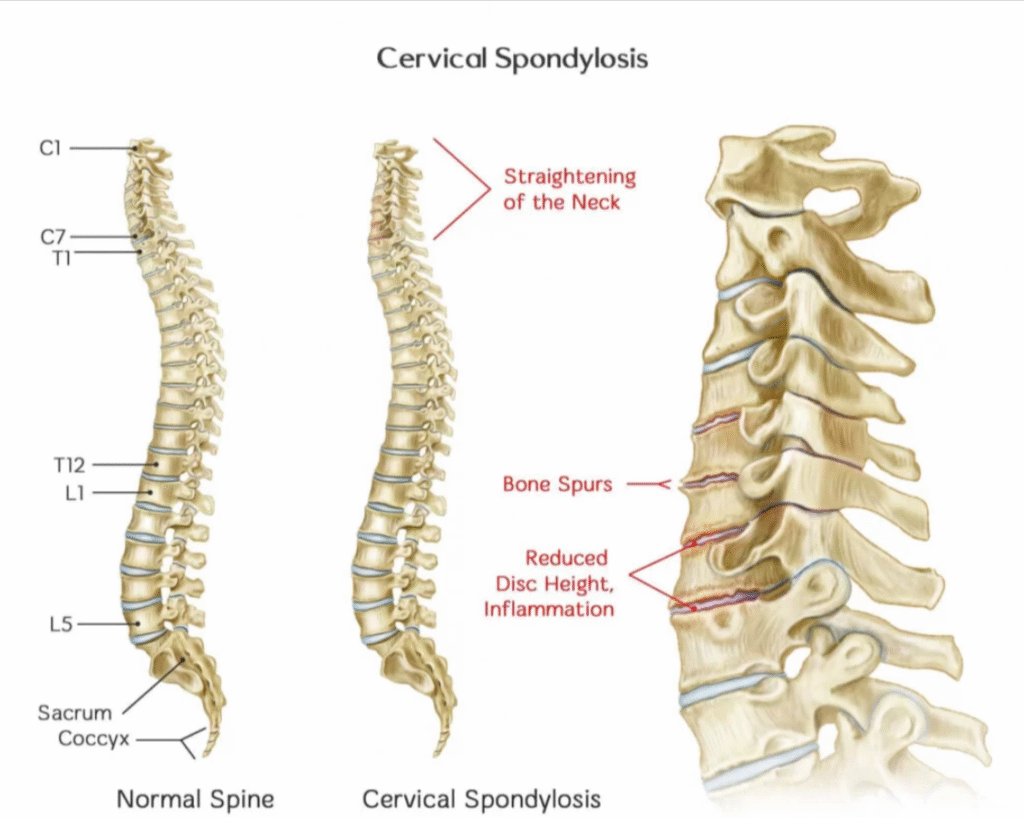 cervical spondylitis
